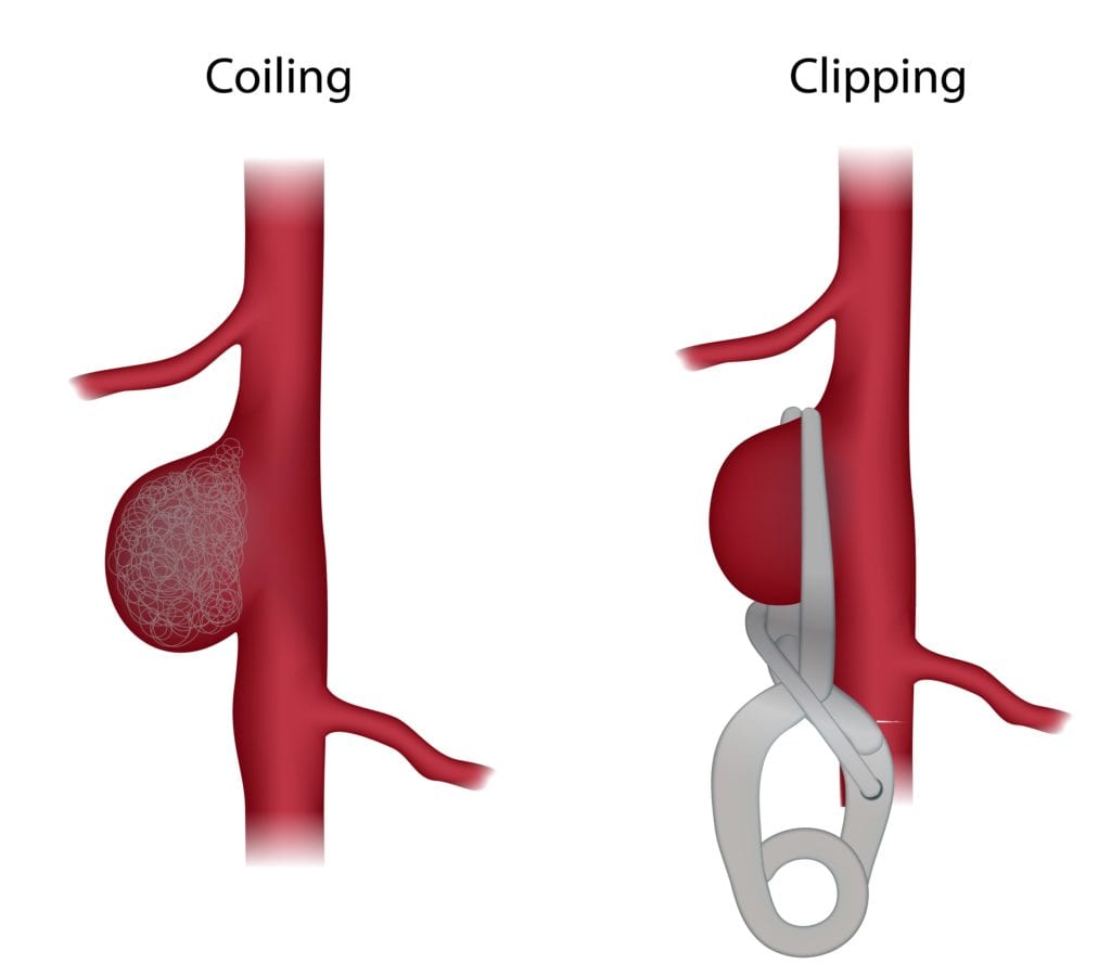 Illustration coiling and clipping