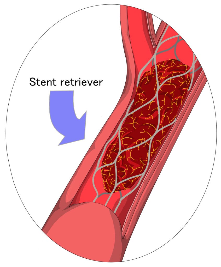 illustration stent retriever